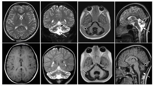 A normal leaf-shaped cerebellum versus cerebella that are reduced in size.